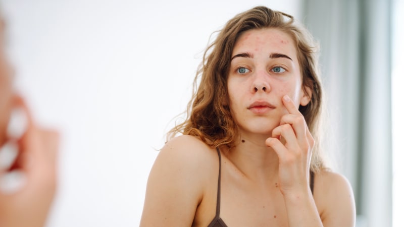 Z trhu zmizí čtveřice léků. Je mezi nimi i roztok na akné, SÚKL zjistil pochybení ve výrobě