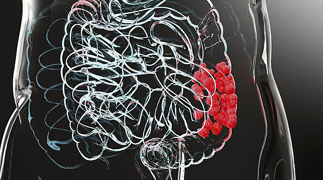 Nebezpečné mýty o rakovině tlustého střeva, kterým byste neměli věřit